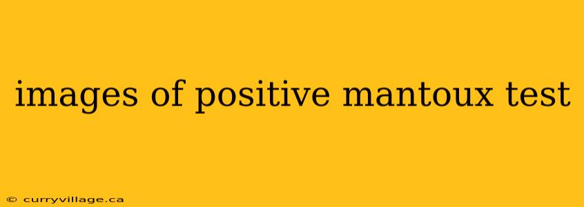 images of positive mantoux test