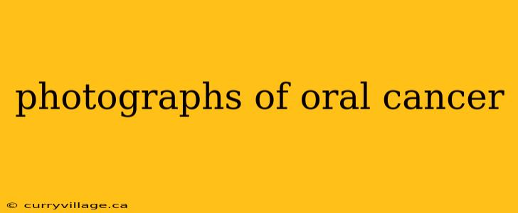 photographs of oral cancer
