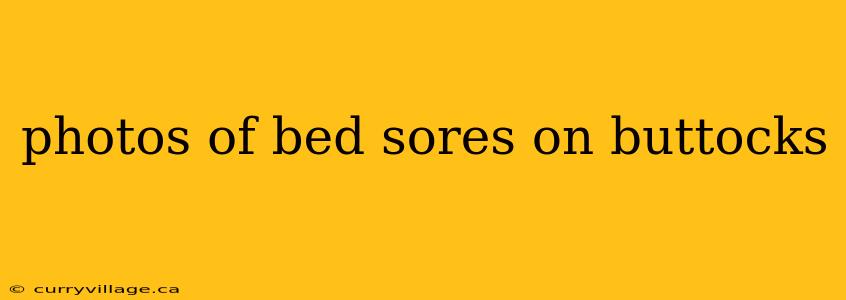 photos of bed sores on buttocks