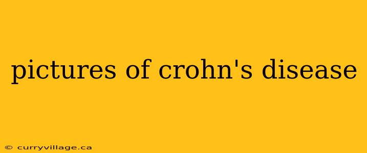 pictures of crohn's disease