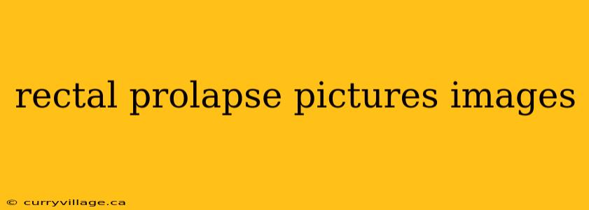 rectal prolapse pictures images