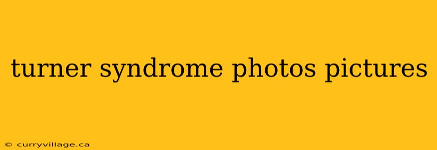 turner syndrome photos pictures